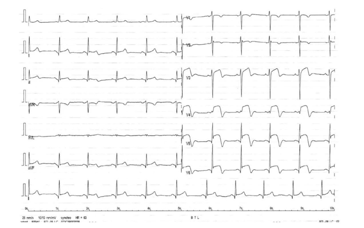Vstupní EKG (archiv autorů)