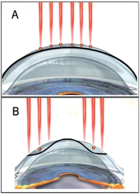 The excimer laser (represented by the red lines) ablates
tissue (yellow arrowheads) in the central and paracentral
areas (A) to correct myopic errors, and in the periphery of the
cornea (B) to correct hyperopic errors