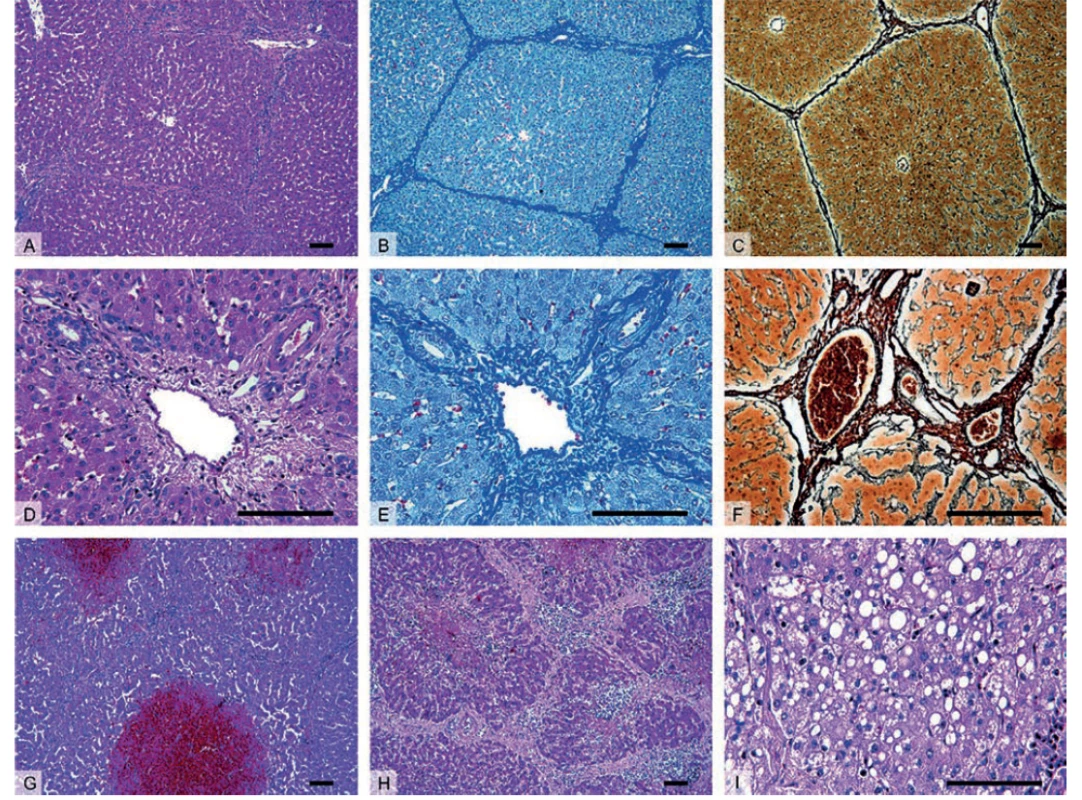 Histologický obraz zdravých (A–F) a patologicky změněných jater prasete (G–I)<br>
A–C – Přehledné zvětšení zobrazující jaterní parenchym členěný v jednotlivé jaterní lalůčky, které jsou u prasete ohraničené oproti
člověku významně větším množstvím vaziva.<br>
D–F – Detail portobiliárních prostor obsahujících hepatickou trias – interlobulární větev a. hepatica propria, v. portae a žlučovodu.<br>
G – Centrilobulární hemoragická nekróza u zvířete se sinusoidálním obstrukčním syndromem vyvolaným experimentální aplikací
pyrrolizidinového alkaloidu monocrotalinu.<br>
H – Nodulární transformace jaterní tkáně s porušenou mikrostrukturou jater a typicky zmnoženým interlobulárním vazivem u jaterní
cirhózy.<br>
I – Steatóza jater charakterizována nahromaděním tukových vakuol v cytoplazmě hepatocytů v důsledku toxického poškození jater.<br>
Barvení: hematoxylin a eosin – přehledné barvení (A, D, G–I), anilinová modř a jádrová červeň – detekce kolagenního vaziva (B, E),
stříbření (impregnační metoda) (C, F) – detekce retikulárních vláken. Měřítka: 100 μm.<br>
Fig. 1: Histology of healthy (A–F) and diseased (G–I) porcine liver<br>
A–C – The liver parenchyma divided into morphological hepatic lobules, in pigs the lobules are demarcated by a signifi cantly higher
amount of connective tissue when compared to human.<br>
D–F – Detail of portal tracts containing bile ducts and branches of the hepatic artery and portal vein surrounded by connective tissue.<br>
G – Centrilobular hemorrhagic necrosis seen in animal with Sinusoidal Obstruction Syndrome, experiment included the application
of alkaloid monocrotaline.<br>
H – Cirrhotic liver histologically represented by nodular transformation of liver parenchyma with disruptions of liver microarchitecture
and excessive amount of interlobular connective tissue.<br>
I – Steatosis characterized by lipid droplets accumulation within hepatocytes caused by toxic liver injury.<br>
Staining: hematoxylin and eosin staining (A, D, G–I), aniline blue staining, counterstained with nuclear fast red – detection of collagen
connective tissue (B, E), silver impregnation technique – detection of reticular fibers.<br>
Scale bars: 100 μm.