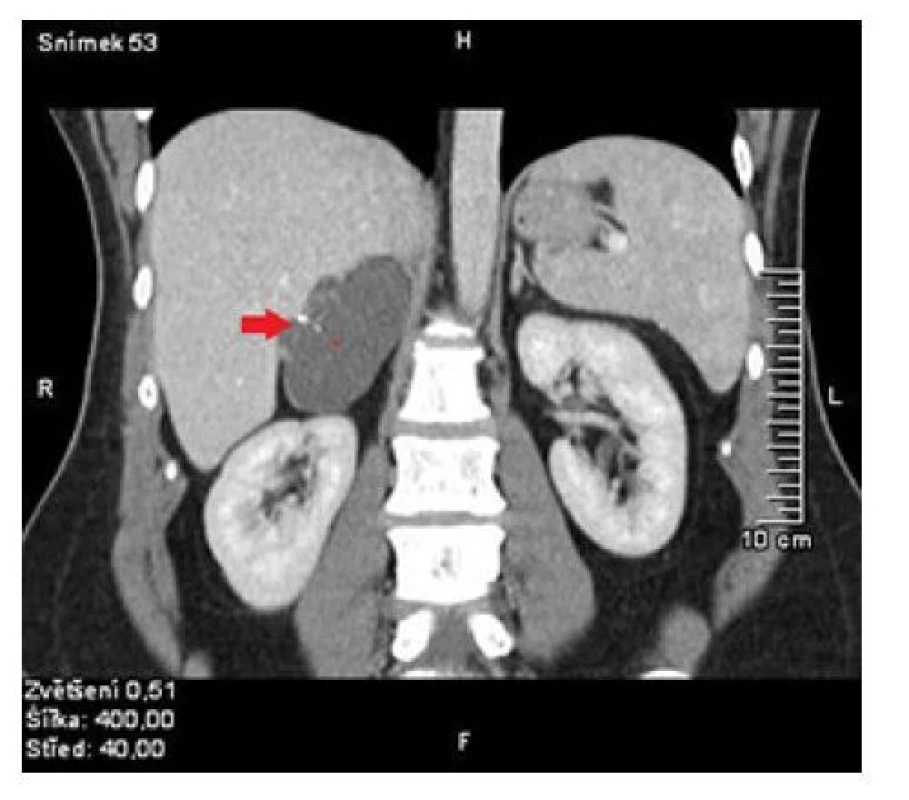 CT břicha, tumor nadleviny označen šipkou<br>
Fig. 1. Abdomen CT, adrenal tumor signed by arrow