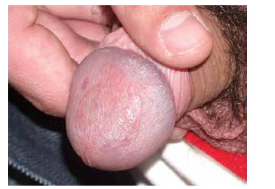 Lichen planus anularis