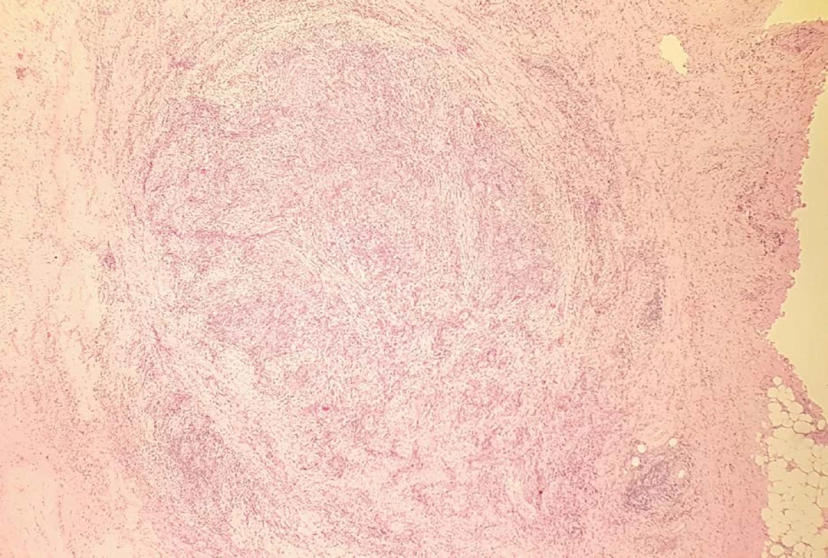Histologický preparát eosinofilní funikulitidy (hematoxylin-eosin, 25x)<br>
Fig. 2. Histological specimen of eosinophilic funiculitis(hemathoxylin-eosin, 25x)