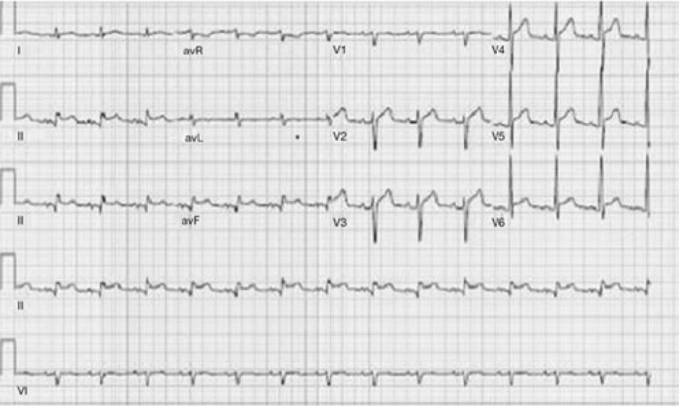 Elevácie ST v II, III, aVF, V5-V6 bez kontralaterálnych depresií ST na 
EKG hodnotené ako inferolaterálny STEMI 