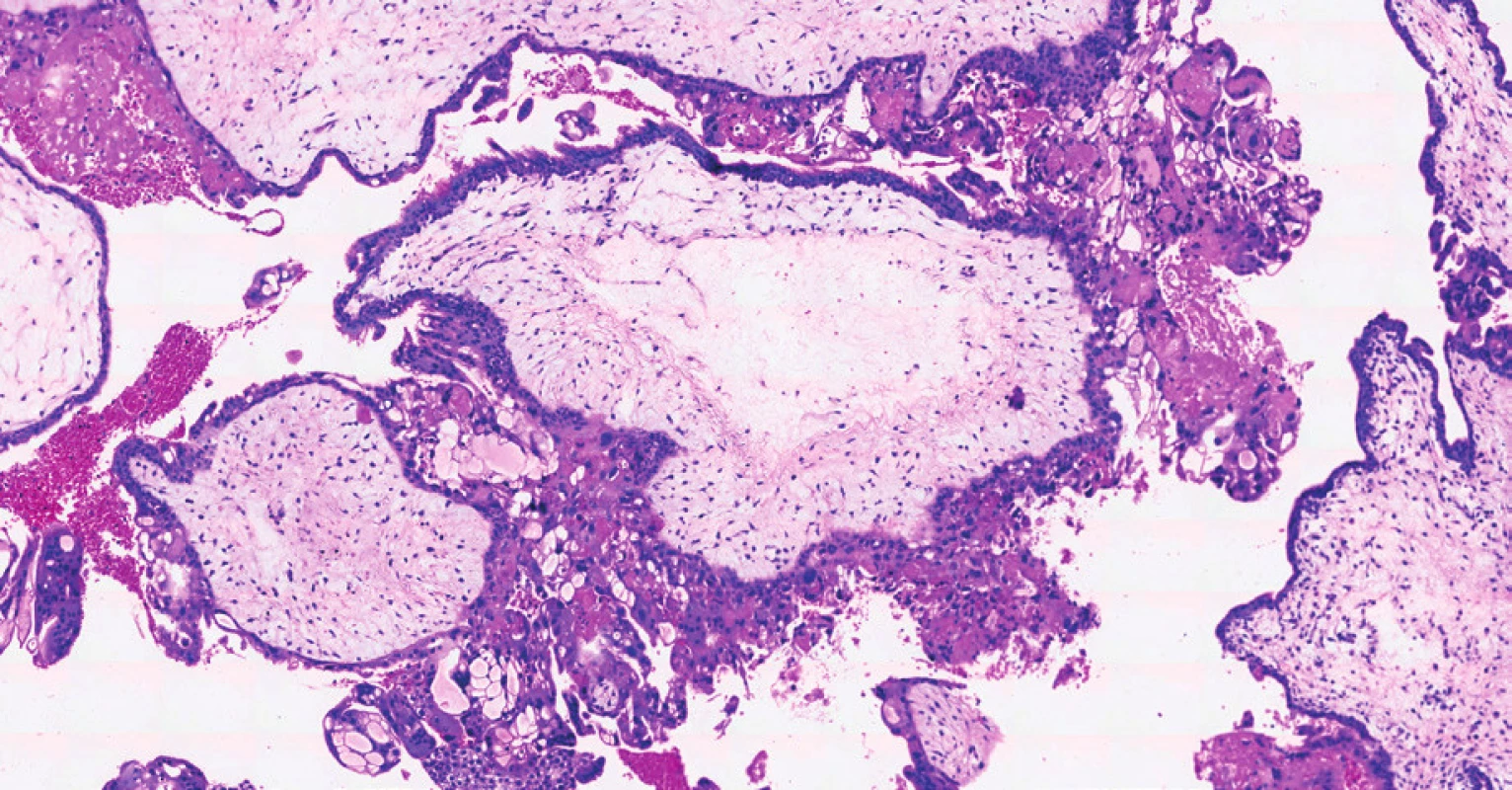 Histologický preparát – hematoxylin, eozin.<br>
Kompletní mola hydatidosa s hydropicky zvětšenými choriovými
klky a s centrální tvorbou cisteren. Nepravidelná, nahodilá
proliferace vilózního trofoblastu.