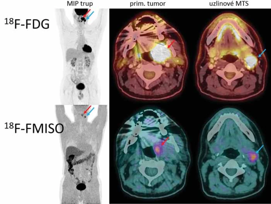 Porovnání diagnostických snímků s 18F-FMISO a 18F-FDG.