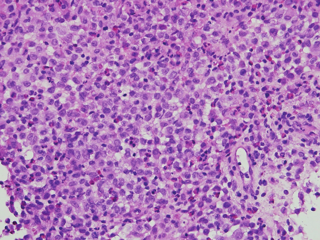 Histiocytóza z Langerhansových bb. (hematoxylin-eosin,
zvětšení 400x)<br>
Langerhansovy buňky mají světlou cytoplazmu a bledá ledvinovitá
jádra se zářezy. Příměs tvoří zejména eozinofily.