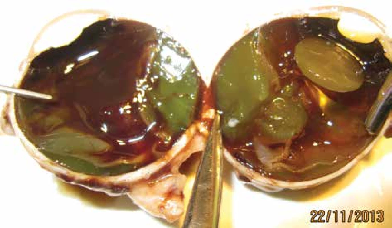 Eyeball after enucleation – lens turbid, secondary amotio
