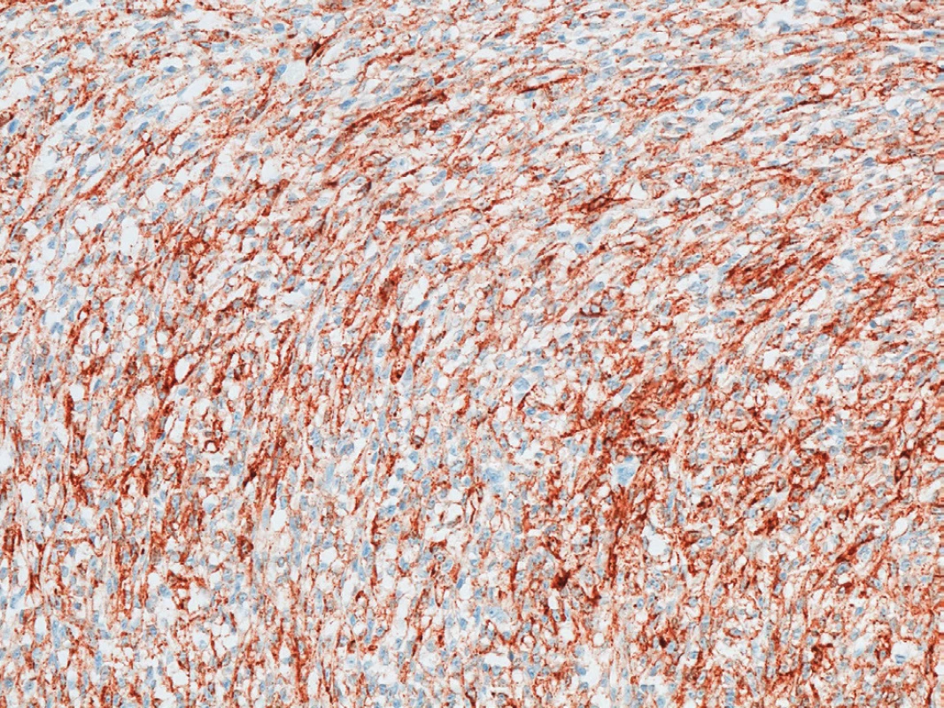 Fokální exprese HMB45<br>
Fig. 3: Focal HMB45 expression