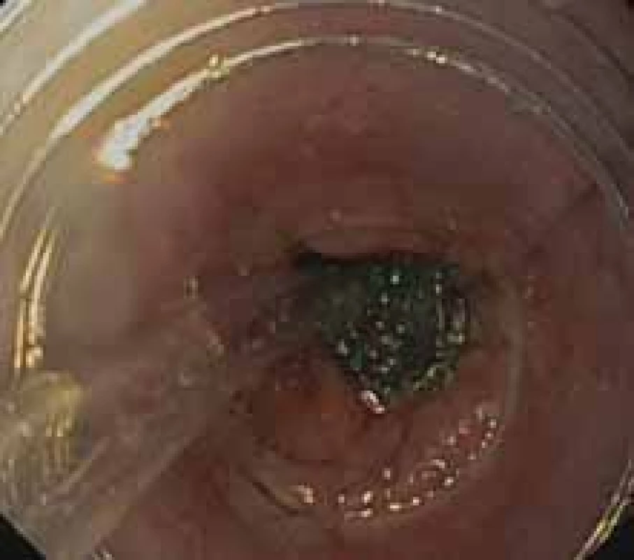 Intraluminal application of endoscopic vacuum assisted closure
using overtube.<br>
Obr. 6. Intraluminální aplikace endoskopické vakuové terapie s použitím
převlečné hadice.