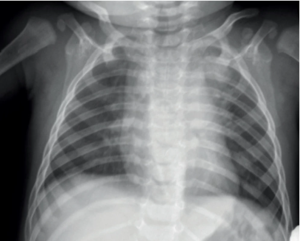SKG hrudníku u 9měsíčního chlapce s TB plic vlevo,
forma infiltrativní, mikroskopicky negativní, kultivačně
pozitivní.<br>
Fig. 3. Chest X-ray of 9 months old boy with pulmonary TB.