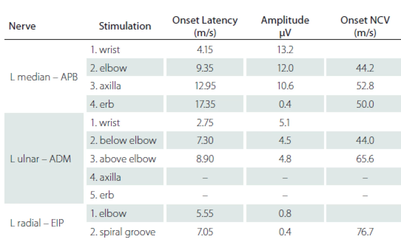 Values of motor nerve conduction study.