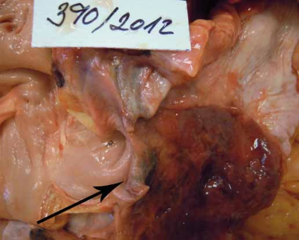 Infiltrace myokardu tumorem.<br>Fig. 3. Myocardium infiltrated by cancer