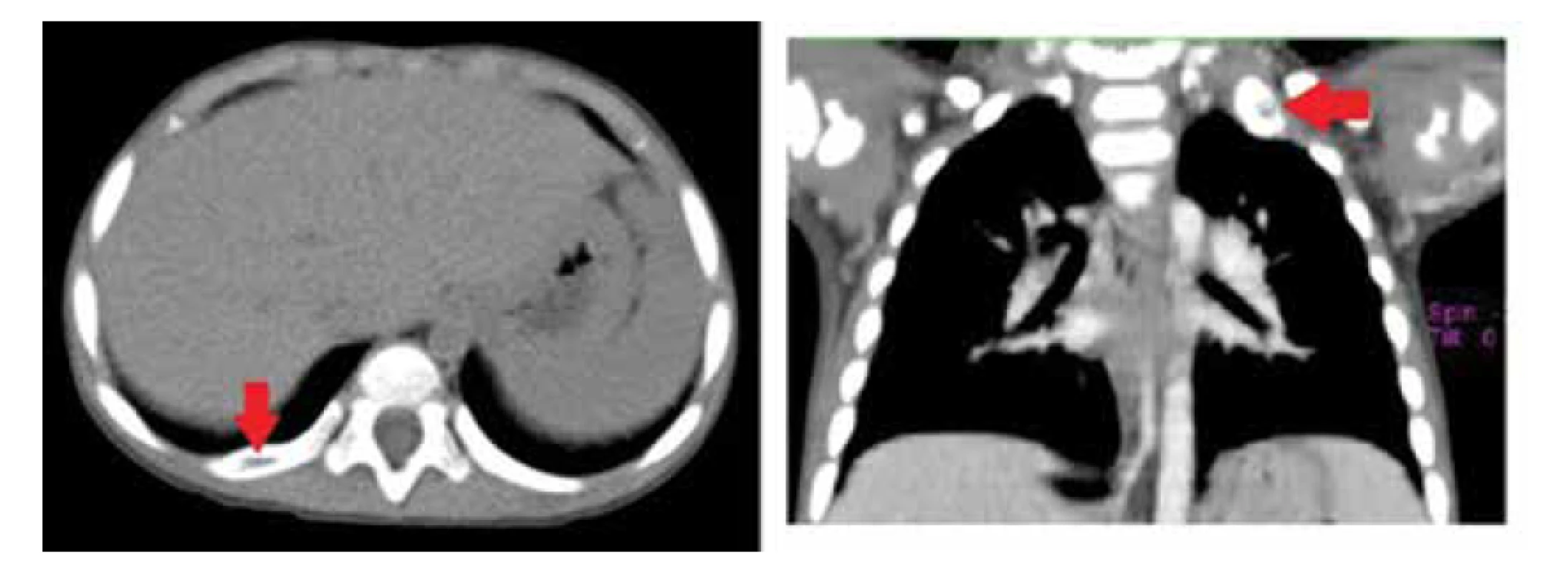 CT nález osteolytických ložísk v rebrách (zdroj: archív autorov).<br>
Fig. 5. Osteolytic lesions in the ribs on CT scan (source: authors’ archive).