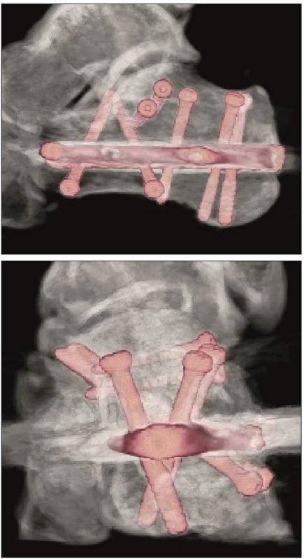 Pooperační VRT obrazy po osteosyntéze zlomeniny patní kosti
hřebem C-nail