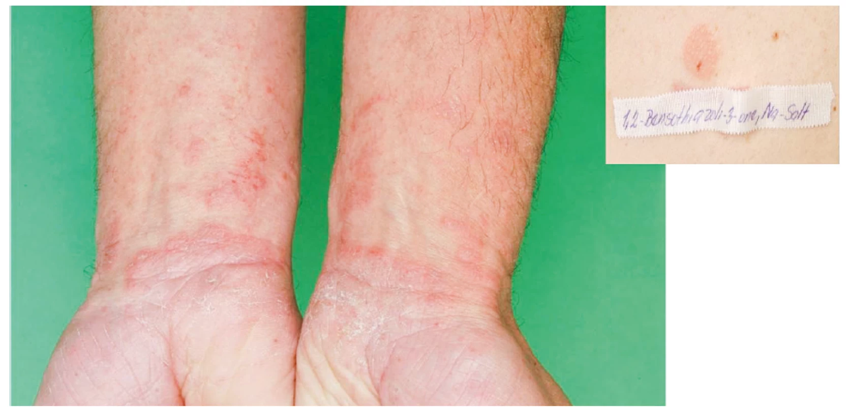 Eczema contactum prof. – atopická báze – benzizothiazolinon – obráběč kovů a záměčník