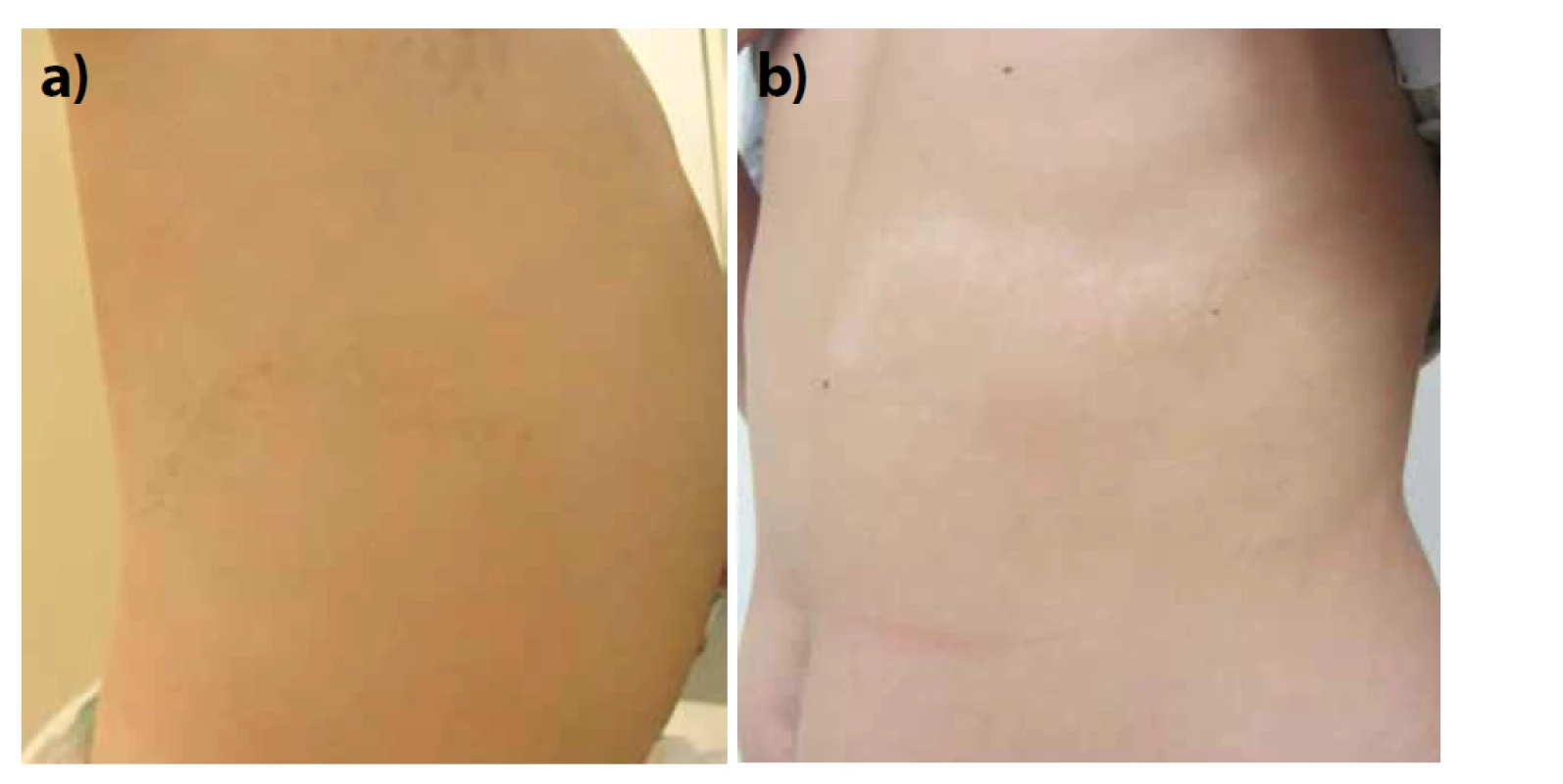 Blaschkovy linie<br>
a) hyperpigmentace, b) hypopigmentace