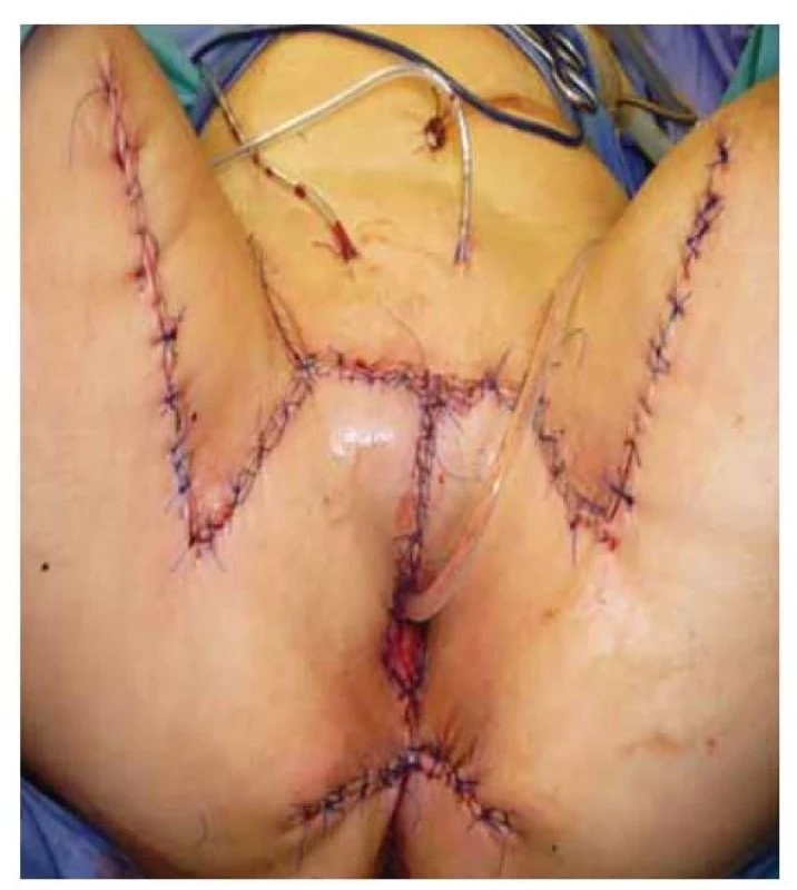 Stav bezprostředně po rekonstrukci s krytím defektu
kožními laloky.<br>
Fig. 3. Condition immediately after reconstruction with skin
flaps covering the defect.