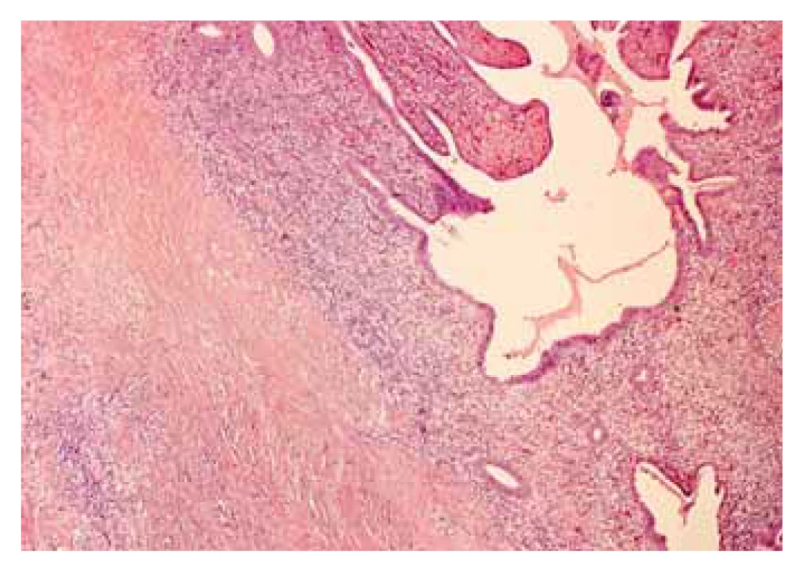 Histologický obraz z útvaru vycházejícího z okruží
terminálního ilea (z archivu plk. prim. MUDr. P. Hrabala,
Patologicko-anatomické oddělení, ÚVN Praha).