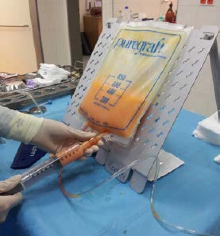Macrofat graft, uzavřený filtrační systém