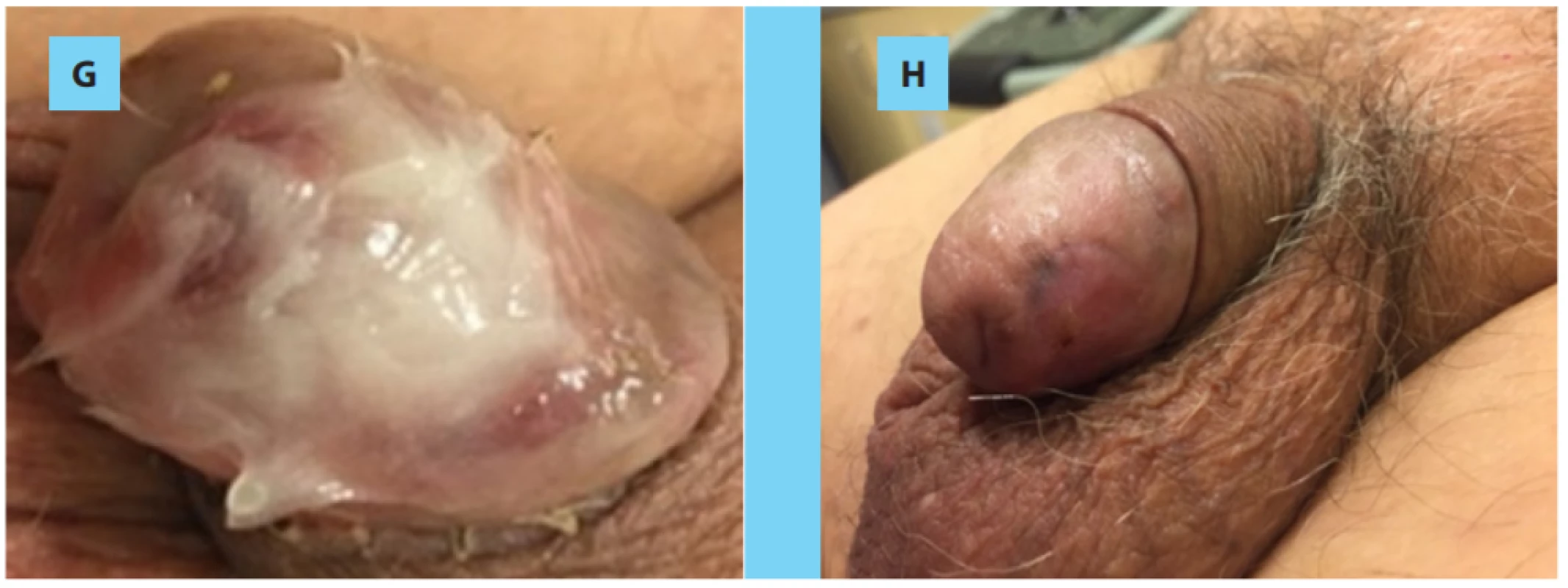 . A) 9 weeks after the primary excision; B) demarcation of the glans area; C) re-excision of the glans;
D) coverage with the Veriset, which was fixed with a few 4.0 resorbable sutures; E) 3rd postoperative day, F) 7
days after the procedure; G) local wound care with vaseline mixed with baneocin cream; H) final appearance
of the glans (week number 8).<br>
Obr. 2. A) Devět týdnů po primární excizi; B) vymezení oblasti glandu; C) reexcize glandu; D) překrytí náplastí
Veriset, která byla připevněna několika vstřebatelnými stehy 4/0; E) třetí pooperační den; F) sedm dnů po zákroku;
G) lokální péče o ránu za použití vazelíny smíchané s mastí baneocin; H) konečný vzhled glandu (8. týden)