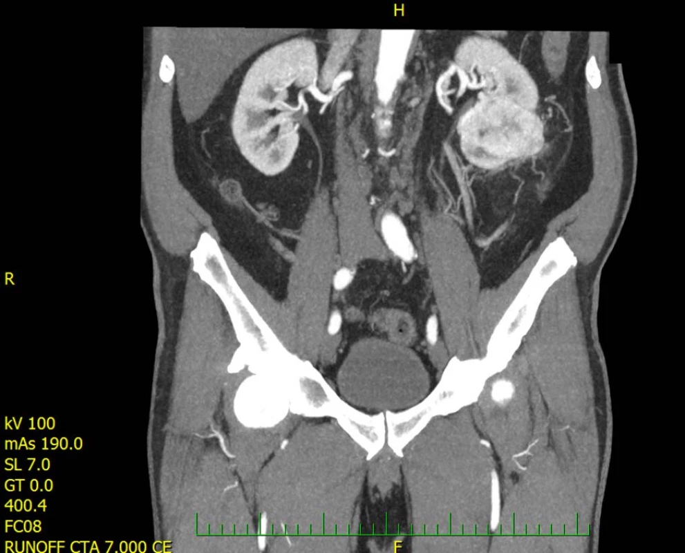 CT zobrazující nádor levé ledviny<br>
Fig. 1. CT scan showing tumor of left kidney
