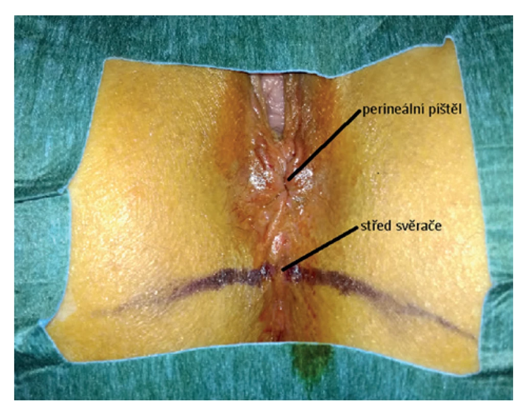 Předoperační stav perineální oblasti s perineální píštělí<br>
Fig. 2: Preoperative condition of the perineal area with the
perineal fistula