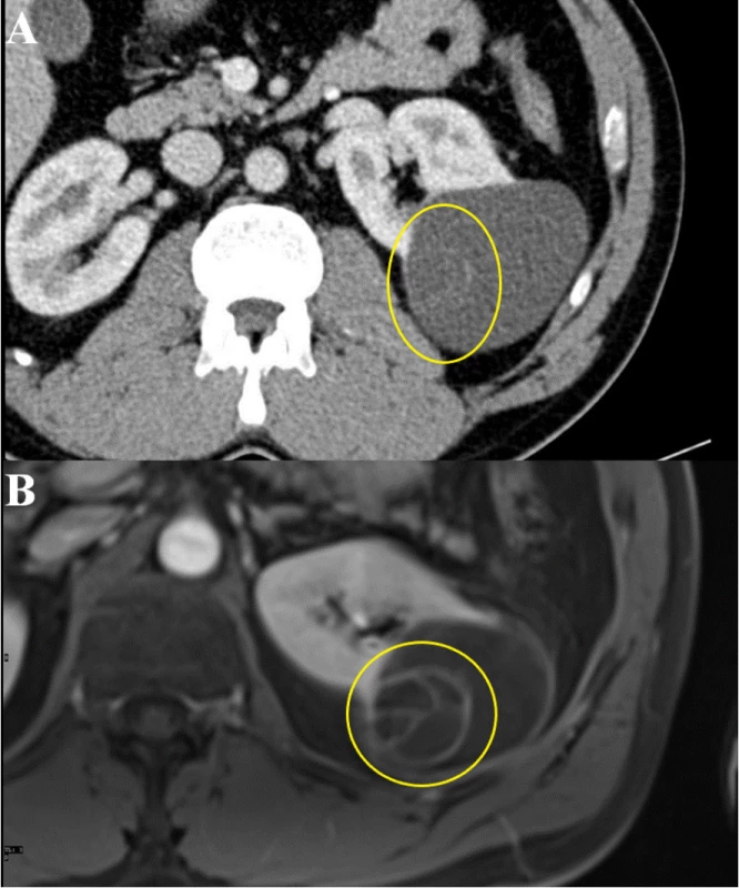 Srovnání téže cystické léze na CT a MR vyšetření
(A – CT, B – MR)<br>
Fig. 2. Comparison of the same cystic lesion on CT and
MRI (A – CT, B – MR)