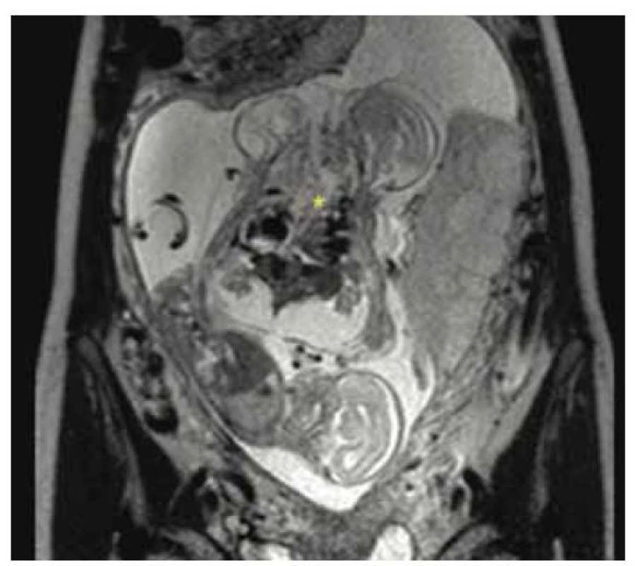 Magnetická rezonance, trojčetná gravidita
komplikovaná přítomností srostlic, 17. týden
těhotenství [14].<br>
Fig. 7. Magnetic resonance imaging, triple pregnancy
complicated by conjoined twins, 17th week of
pregnancy [14].