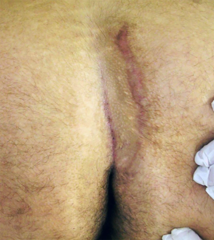 Neo-rima ani a nové primární zevní ústí<br>
Fir. 8: Neo-rima ani with new pits