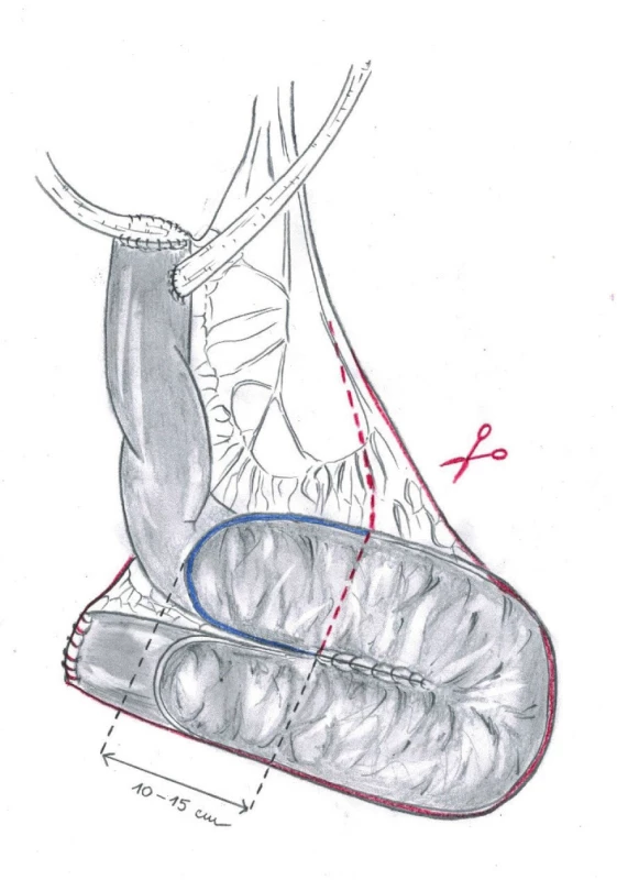 Červená linie ohraničuje část neoveziky, která
se odstraní při operaci<br>
Fig. 3. The red line delineates the part of neobladder to
be removed during the surgery