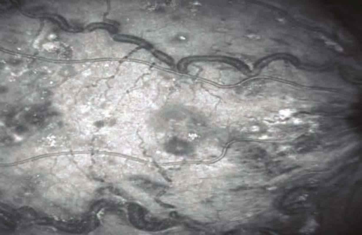  Image from video of fundus on optical coherence tomography of right eye: macula infiltrated, haemorrhages and hard exudates, pronounced dilation and tortuosity of blood vessels with visible whitish deposits in capillary lumen 