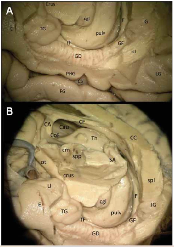 (A) Gyrus dentatus (detail). (B) Širší zapojení GD v Papezově okruhu. <br>
Fig. 2 (A) Right gyrus dentatus (detail). (B) Wider involvement of the right GD
in the Papez circuit.
