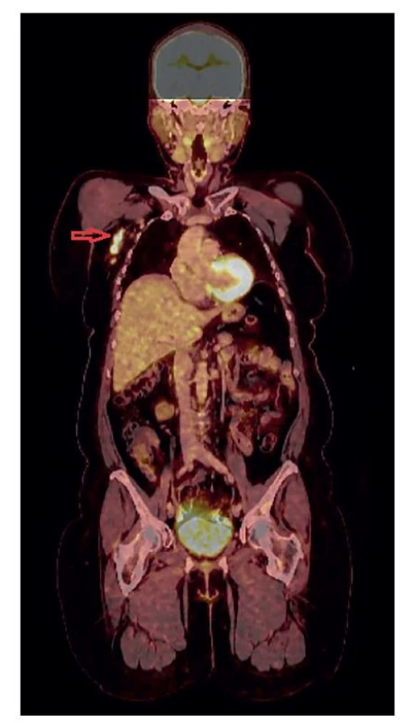 PET/CT vyšetření zobrazující zvýšenou akumulaci
glukózy ve vícečetných povrchových i hlubokých LU pravé
axily (šipka).<br>
Fig. 5: PET/CT showing increased glucose accumulation
in multiple superficial and deep lymph nodes of the right
axilla (arrow).