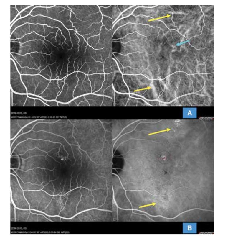 Multimodální zobrazení chronické formy centrální serózní chorioretinopatie u 52leté pacientky s extrafoveolárními ložisky
(HRA-OCT Spectralis Heidelberg): (A) simultánní snímek fluorescenční a indocyaninové angiografie zobrazující časnou arteriovenózní
fázi s výraznou dilatací choroidálních cév extrafoveolárně (žluté šipky) a perifoveolárně (modrá šipka); je patrné difuzní narušení
choriokapilaris v centrální oblasti, snímek zároveň neprokazuje přítomnost choroidální neovaskularizace. (B) simultánní snímek fluorescenční
a indocyaninové angiografie znázorňující pozdní venózní fázi angiogramu s vyznačenými ložisky difuzní hyperfluorescence
zejména na indocyaninovém zobrazení (žluté šipky) a vyznačenou stopou pro redukovanou fotodynamickou terapii v místě difuzního
aktivního ložiska (fialový kruh)