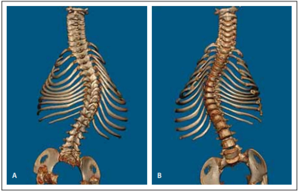 Předoperační vyšetření 3D CT celé páteře (A, B).<br>
Fig. 2. Předoperační vyšetření 3D CT celé páteře (A, B).