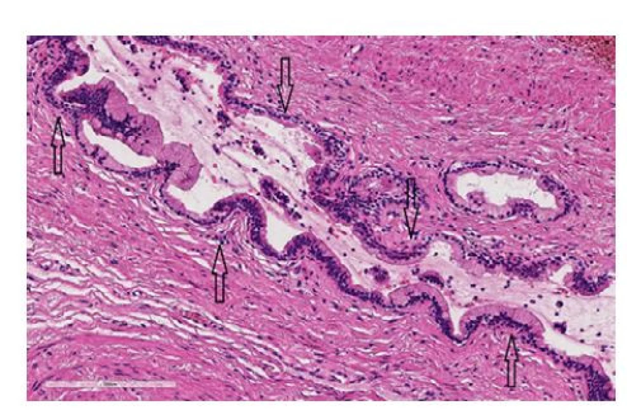 a. Biopsie kompletně extirpované cystické
formace s obsahem: dilatovaná Littrého žláza (ohraničena
šipkami) s výstelkou kubického epitelu (barvení
HE, zvětšení 200×)<br>-
Fig. 5a. Biopsy of the completely extirpated cystic
mass with its content: dilated Littré’s gland (marked
by arrows) with a lining of cuboidal epithelium. (HE
staining, magnification of 200×)