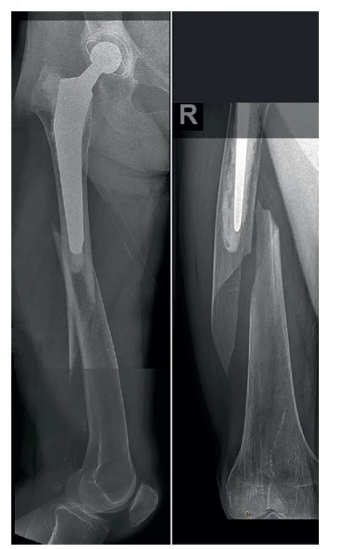 Periprotetická fraktura diafýzy pravého femuru –
úrazový snímek<br>
Fig. 1: Periprosthetic fracture of the right femoral diaphysis
– initial X-ray