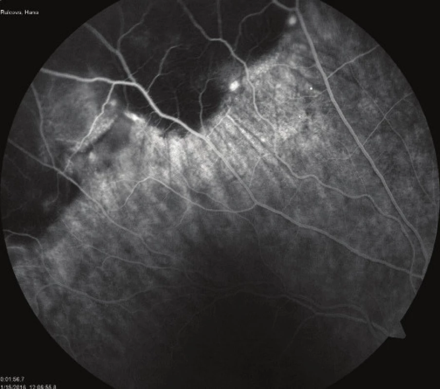 FA of peripheral lesions – blockade of basal fluorescence
in LE