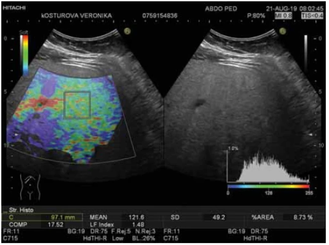 Ultrasound evaluation of liver elasticity using real-time elastography – obese
paediatric patient; LFI = 1.48. <br> 
Obr. 3. Ultrazvukové hodnotenie elasticity pečene pomocou elastografi e v reálnom čase –
obézny detský pacient; LFI = 1,48.