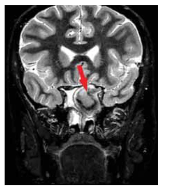 Nehomogenní zastření klínové
dutiny (šipka), útlak n. opticus
vlevo, MR vyšetření, koronární řez.<br>
Fig. 3. Inhomogeneous obstruction of
the wedge cavity (arrow), oppression
of the optic nerve to the left, MRI examination,
coronary incision.