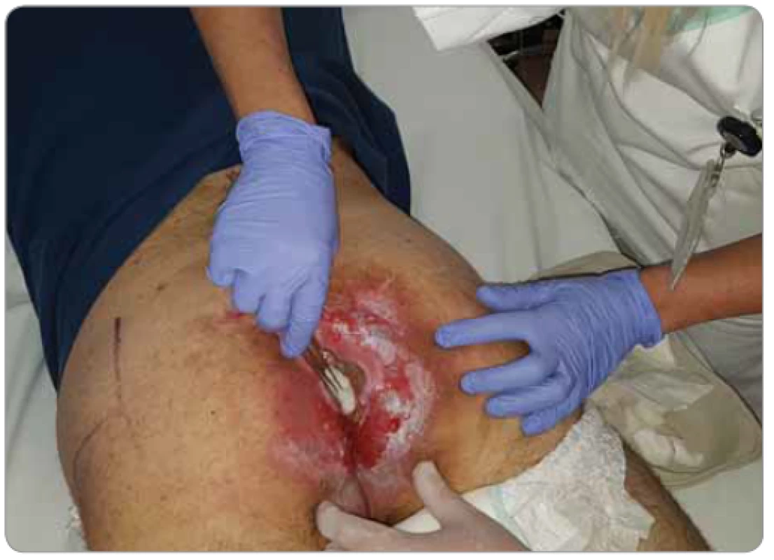 Ošetřování pacienta s akutní radiodermatitidou s erytémem a exfoliací krátce
po radioterapii exulcerovaného karcinomu kůže v sakrokokcigeální oblasti (foto S. Vokurka,
FN Plzeň).