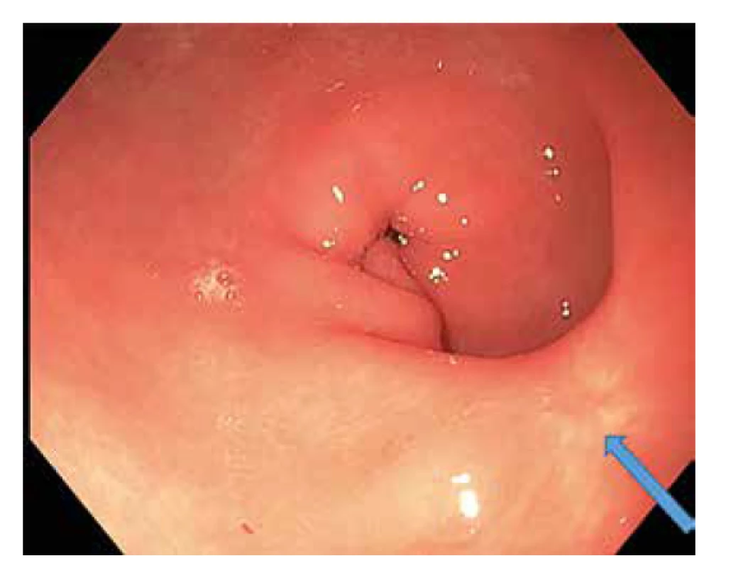 Endoskopický pohled na spastický pylorus s jizvou
na velké kurvatuře po předchozím G-POEM<br>
Fig. 1: Endoscopic view of the narrow pylorus with the
scar after the first G-POEM