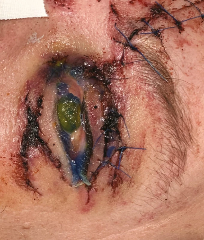 Photograph shows a rarer complication of oculoplastic traumas – patient after injury (traffic accident) – probably
loss injury of upper eyelid following primary reconstruction
– with a finding of exposure keratitis with lagophthalmos
upon a background of inability to close ocular aperture