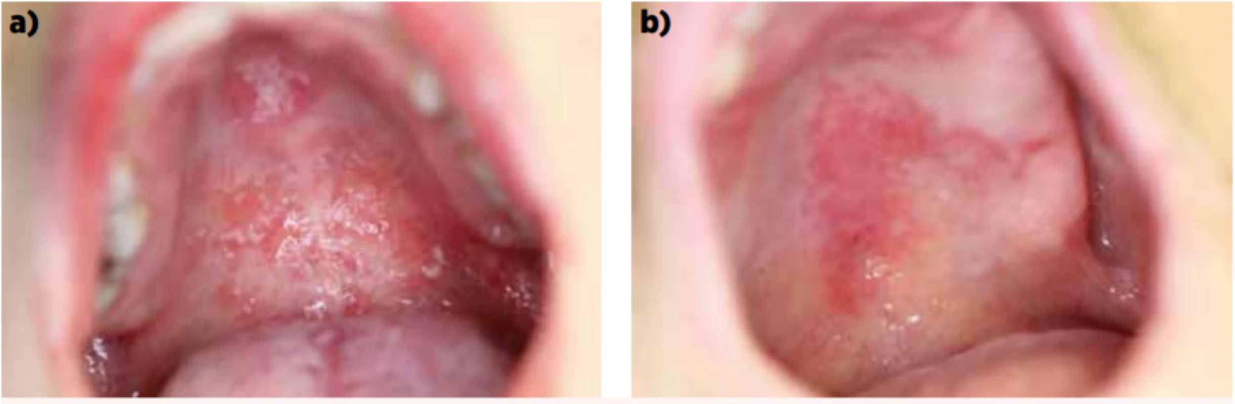 Orální kandidóza: a – pseudomembranózní forma, b – erytematózní forma