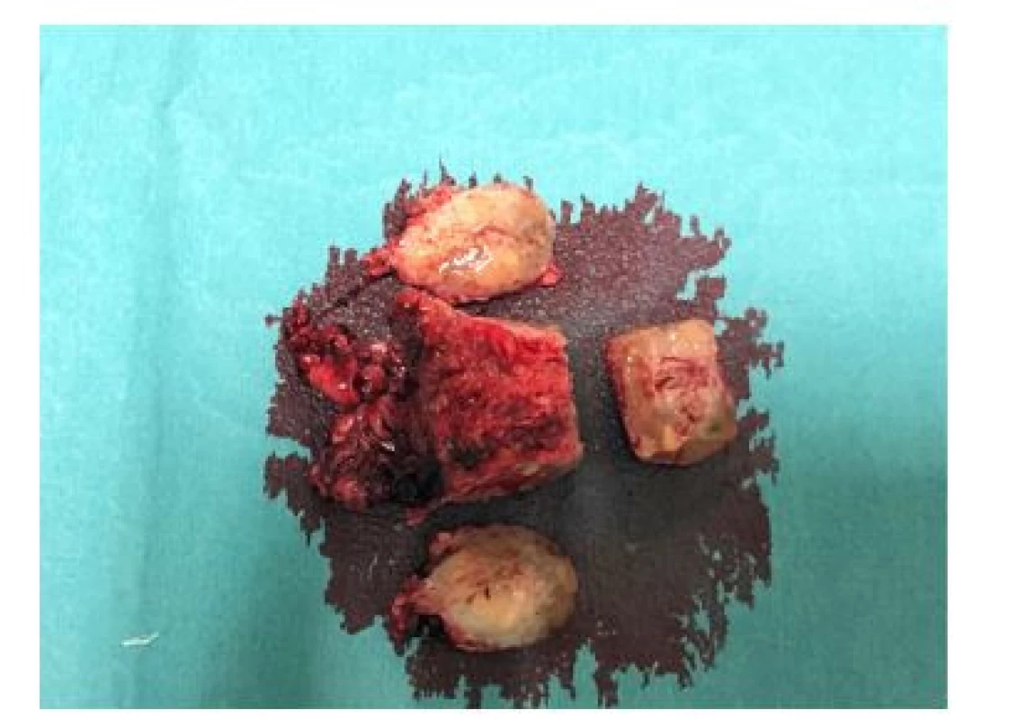 Příprava preparátu na IFS, pravý a levý laterální
okraj a apex před barvením<br>
Fig. 4. Preparation of the prostate for IFS, right and left
lateral margins and apex before staining