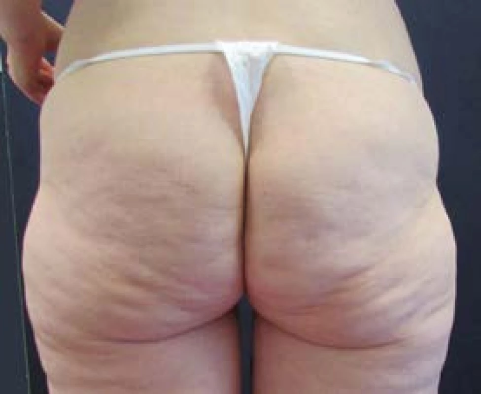 Gluteoplastika, 25letá pacientka po redukci hmotnosti o
45 kg – předoperační foto.