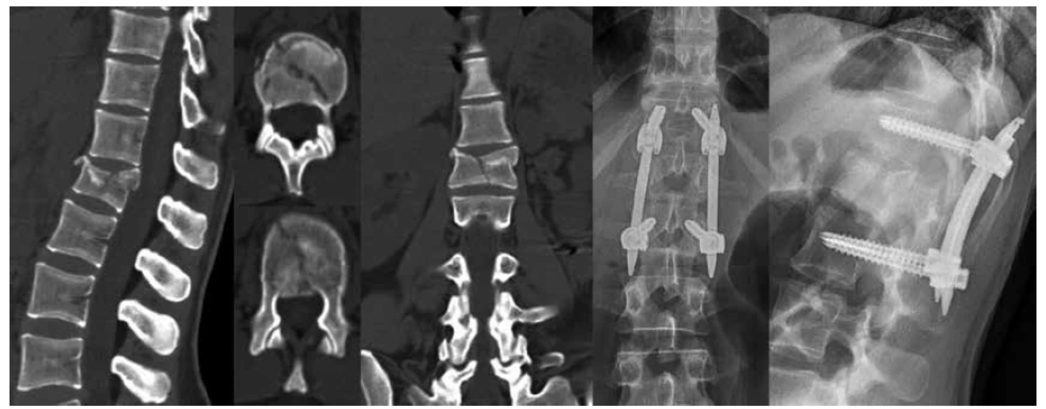 Zlomenina L1 kompletní tříštivá (A4), bez neurologické léze (N0) TL AOSIS – 5, řešena miniinvazivní
transpedikulární instrumentací ze zadního přístupu<br>
Fig. 1. Complete burst fracture of L1 (A4), without neurological deficit (N0) TL AOSIS – 5, treated by minimal
invasive transpedicular instrumentation from posterior approach