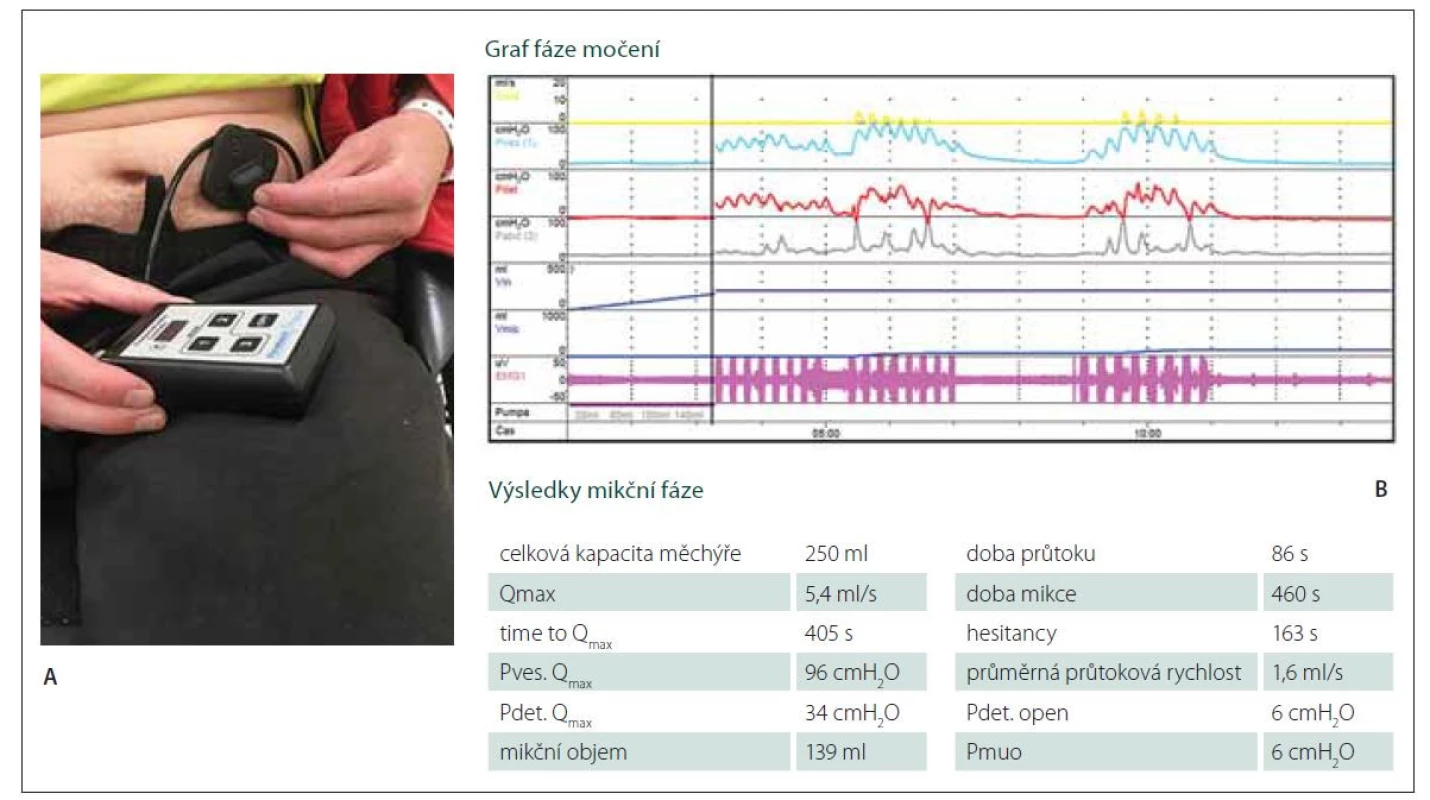 Výsledek urodynamického vyšetření 1 rok od operace.<br>
(A) Autostimulace pacientem 1 rok po implantaci Brindleyho stimulátoru. (B) Výsledek urodynamického vyšetření 1 rok od operace. Horní,
žlutá křivka ukazuje vlastní fázi močení vyvolané aktivací Brindleyho stimulátoru.<br>
Fig. 2. Results of urodynamic assessment 1 year after surgery.<br>
(A) Auto-stimulation 1 year after Brindley stimulator implantation. (B) Results of urodynamic assessment 1 year after surgery.
The upper (yellow) curve shows a phase of voiding induced by activation of the Brindley stimulator.