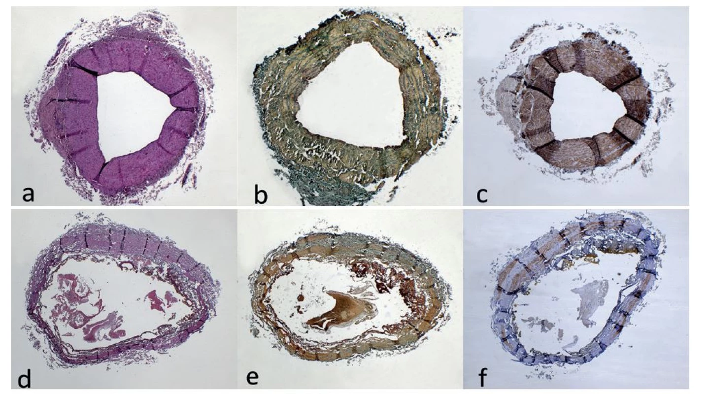 Histologické a histochemické vyšetření úseků VSM bez ošetření laserem (a,b,c) a po ošetření laserem (d,e,f)<br>
a) Obraz venózní stěny s varikózní přeměnou. Hematoxylin-eosin, originální zvětšení 20x. b) Venózní stěna s pravidelnou kontinuální
distribucí a organizací elastických vláken. Orcein, originální zvětšení 20x. c) Svalovina medie bez zřetelné disrupce, s adhezí
hladkosvalových struktur. IHC SMA, originální zvětšení 20x. d) Obraz těžkých regresivních změn odpovídajícím „high-temperature
damage“. Hematoxylin-eosin, originální zvětšení 20x. e) Regresivní změny se ztrátou intimy a disrupcí až ztrátou elastických vláken.
Orcein, originální zvětšení 20x. f ) Rozsáhlá deplece svaloviny medie s její vakuolizací a úsekovou verifikací reziduálních hladkosvalových
struktur. IHC SMA, originální zvětšení 20x.<br>
Fig. 4: Histological and histochemical analysis of GSV sections without laser treatment (a,b,c) and after laser treatment (d,e,f)<br>
a) Image of a venous wall with varicose transformation. Hematoxylin-eosin, original magnification 20×. b) Venous wall with regular
continuous distribution and organization of elastic fibers. Orcein, original magnification 20x. c) Muscle layer of the media without
disruption, with adhesion of smooth muscle structures. IHC SMA, original magnification 20x. d) Image of severe regressive changes
corresponding to “high-temperature damage“. Hematoxylin-eosin, original magnification 20x. e) Regressive changes with loss
of intima and disruption or loss of elastic fibers. Orcein, original magnification 20x. f ) Extensive depletion and vacuolation of the
muscle layer of the media with focal verification of residual smooth muscle structures. IHC SMA, original magnification 20x.