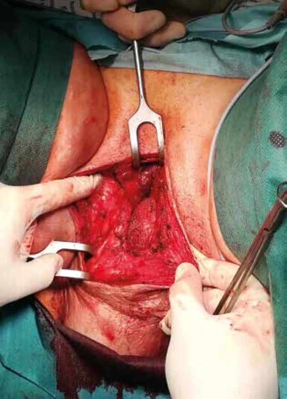 Síťka v pozici sublay z perineálního přístupu<br>
Fig. 3: Sublay mesh from perineal approach